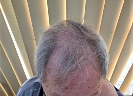 中風後遺症-86歲男性