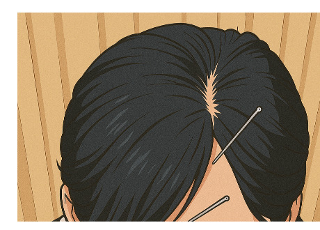 醫案分享-突發性耳聾